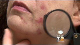 Traditional Treatments Becoming Resistant To Adult Acne