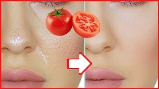 How to Get rid of Oily Skin Permanently - Home Remedies for Oily Skin & Pimples - Get Glowing Skin