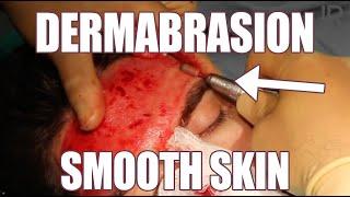 Dermabrasion for Smooth Skin Acne Scars Treatment and Smaller Pores