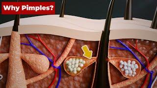 Why do we get PIMPLES? 3D Animation #Shorts