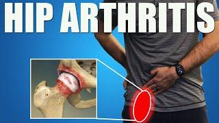 HIP OSTEOARTHRITIS.  BEST Exercises Stretches & Advice for Hip & Groin Pain Relief