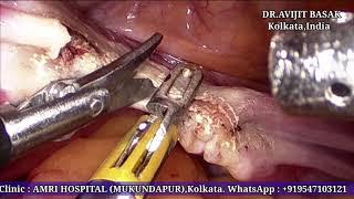 Total Laparoscopic Hysterectomy with BSO by Dr.Avijit Basak TLH BSO