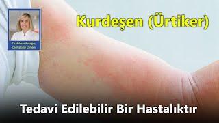 Kurdeşen Ürtiker Tedavi Edilebilir Bir Hastalıktır - Dr. Aslıhan Kırkağaç