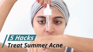 Treat Summer Acne & Pimples  Hacks for Acne Prone Skin