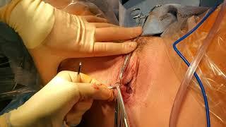 Bartholins Gland Cyst- marsupialization surgery