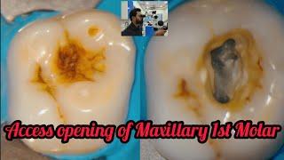 Access opening of Maxillary 1st Molar#step by step rootcanal treatment
