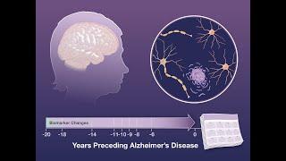 Biomarker Changes Preceding Alzheimer’s Disease  NEJM