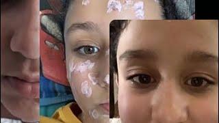 My chicken pox experience  day 1 to day 21  last day  Aileenkamal