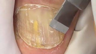 Safe treatment of onychomycosis professional cleaning【Foot Scalpel】