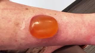 Mosquito Bite Filled With JELLY Gets Popped