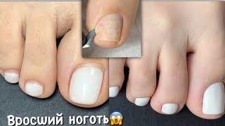 ПЕДИКЮР. Вросший ноготь. Педикюр сама себе