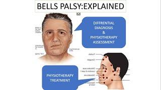 Bells Palsy-Differential Diagnosis AssessmentTreatmentCan you really predict patients prognosis?