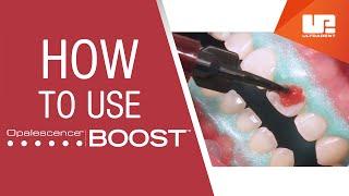 How to Use Opalescence™ Boost™ Professional Teeth Whitening  Step-by-Step Procedure