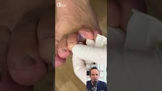 DOCTOR REACTS FUNGUS INFECTION BETWEEN TOES #shorts #reaction