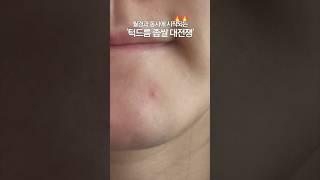 좁쌀 여드름 흔적없이 피부가 깨끗한 이유  올리브영 트러블 패치 추천템 #좁쌀패치