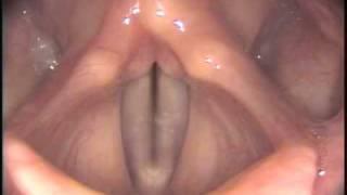 Stroboscopy Rigid Normal female vocal cords - glide up