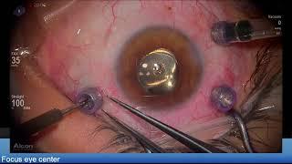Silicone oil removal retinal detachment Lukan Mishev Live Stream