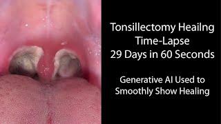 Healing Time Lapse After Tonsillectomy 0-29 Days in 60 Seconds