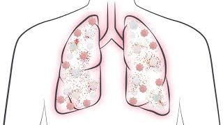 See how a Cytokine Storm can impact COVID-19 patients  What do IL-6 levels tell you?