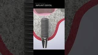 Nâng xoang ghép xương khi cắm implant #dentist #implant #nhakhoa