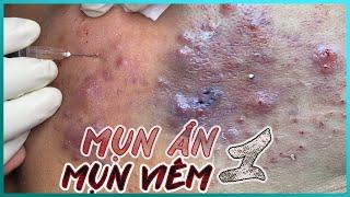 Big Cystic Acne Blackheads Extraction Blackheads & Milia Whiteheads Removal Pimple Popping