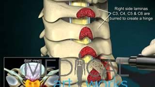 Medical Animation  3 Level cervical open door laminoplasty C3 C4 C5 C6