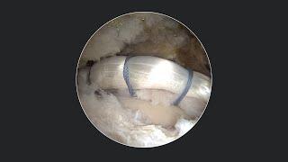 Labral Augmentation Using Knotless 1.8 FiberTak® Anchors Gen2