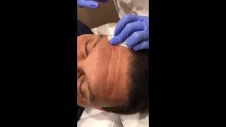 Deep Forehead Lines Removed by Belotero Filler in NYC