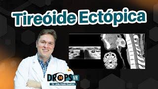 APRENDA COMIGO SOBRE TIREOIDE ECTÓPICA I VOCÊ RADIOLOGISTA