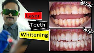 Teeth Whitening With Laser  Fastest & Safest way