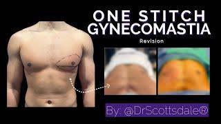 One Stitch Gynecomastia by @DrScottsdale