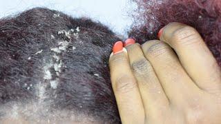 ITCHY DRY SCALP  SCRATCHING DANDRUFF