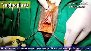 Vaginal tightening surgery  VAGINOPLASTY by DR.AVIJIT BASAK