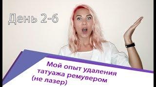 Удаление татуажа бровей ремувером у Виктории Томашивской. Первая неделя после процедуры.