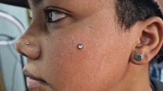 Microdermal