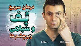 درمان پف و سیاهی زیر چشم  How to get rid of eye bags