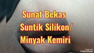 Sunat Dewasa bekas suntik silikonminyak kemiri