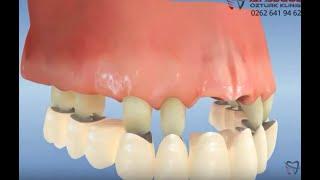 Full mouth dental crowns application after multiple tooth loss