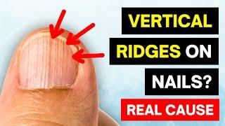 Thats The REAL Cause of VERTICAL RIDGES On Your Nails