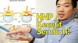 Sakit pinggang Sembuhin saraf kejepit  kecetit  HNP dengan 2 latihan rehabilitasi