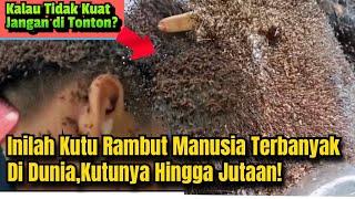 Kutu Rambut Manusia Terbanyak di Dunia  Kutunya Hingga Jutaan ⁉️