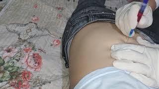 intramuscular injection b12 into the gluteal muscle. intramuscular injection 