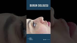 BURUN DOLGUSU  ÖNCESİ VE SONRASI