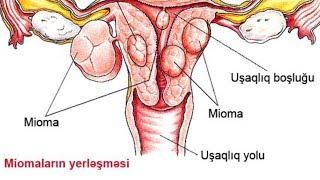 Uşaqlığın mioması və  kista nədir  Hansı hallarda əməliyyat olunmalıdır?