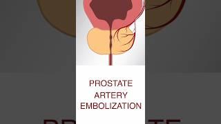 What is Prostate Artery Embolization - Dr Arpit Taunk Apollo Hospital Lucknow