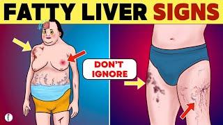 Fatty Liver Symptoms 2024 Update  Fatty Liver Disease  Non Alcoholic Fatty Liver Disease