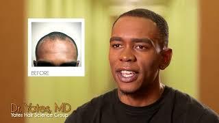 Chicago Hair Transplant with Dr. Yates for African American Hair