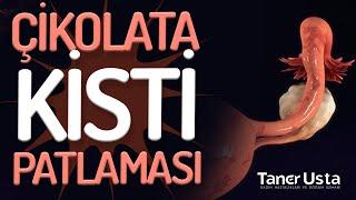 Çikolata Kisti Patlarsa Ne Olur? - Prof. Dr. Taner Usta