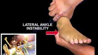 Chronic Lateral Ankle Instability - Everything You Need To Know - Dr. Nabil Ebraheim