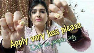 How to Remove Pimples Acne & Whiteheads in 2 days Step by Step  Very less to be dab only on Pimple